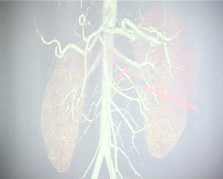 Operaţie de mare risc la Institutul de Transplant Renal VIDEO