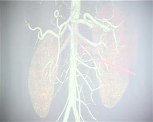 Operaţie de mare risc la Institutul de Transplant Renal VIDEO