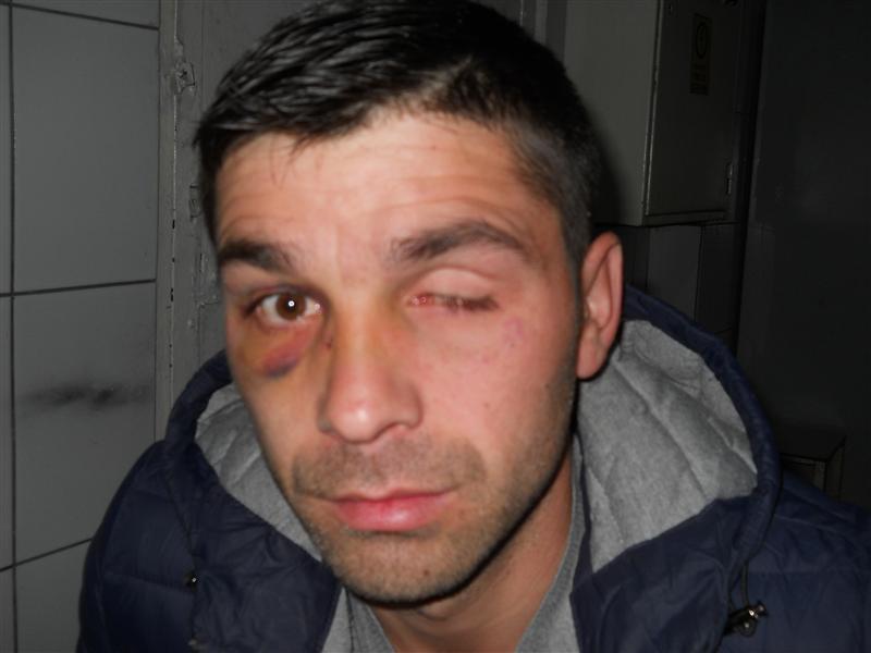 Dintr-un pumn, un bărbat nebisericos i-a zburat unui tânăr proteza oculară şi i-a învineţit ochiul valid