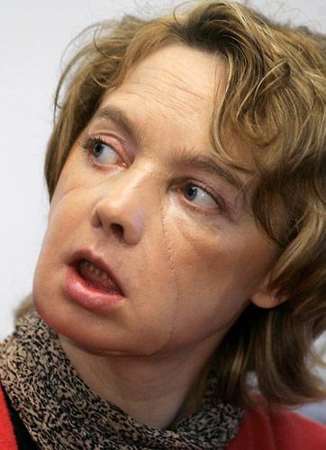 Femeia cu primul transplant de faţă din lume a murit
