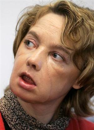 Femeia cu primul transplant de faţă din lume a murit