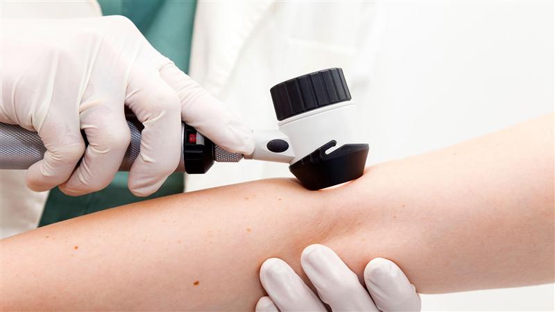 Primul registru electronic naţional al pacienţilor cu melanom, lansat la Cluj