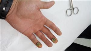 Scandal la un spital din Cluj | Pacient operat la degetul greşit şi certat de medic că nu şi-a ţinut mâna bine