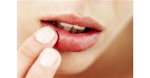 Cum să scapi de herpes cu tratamente făcute în casă 