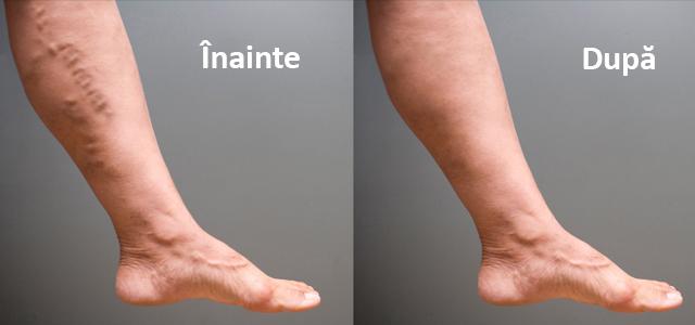 Probleme cu varicele? Iată câteva remedii naturale