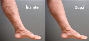 Probleme cu varicele? Iată câteva remedii naturale