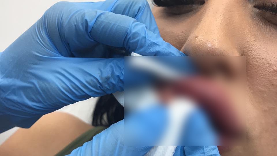 Atenţie la falşii "specialişti" în înfrumuseţare. Ce a păţit o femeie din Cluj care şi-a injectat buzele