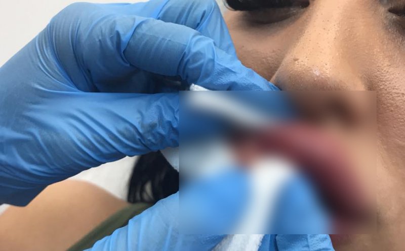 Atenţie la falşii "specialişti" în înfrumuseţare. Ce a păţit o femeie din Cluj care şi-a injectat buzele