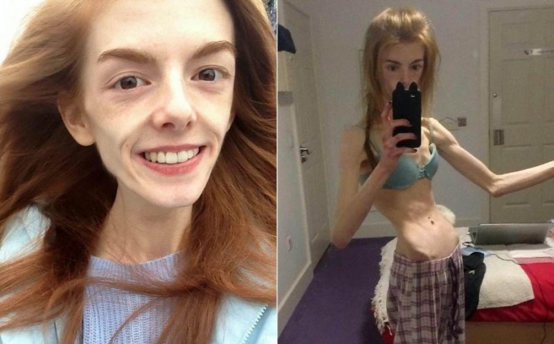 Cum arată acum tânăra care acum 6 ani avea 29 kg și mânca o felie de pâine pe zi