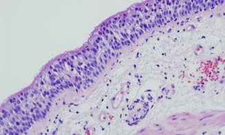 O tehnologie spaţială va fi folosită pentru a accelera diagnosticarea cancerului intestinal