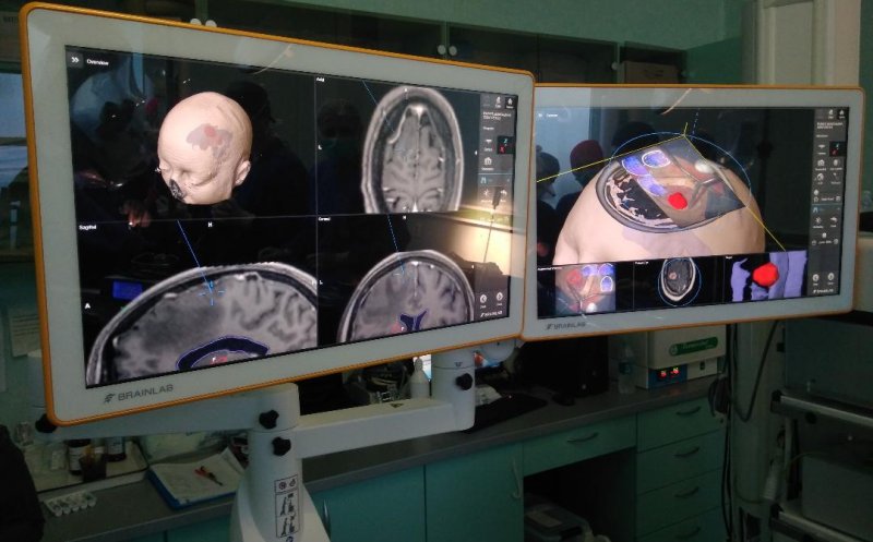 Operații cu un nou sistem de neuronavigaţie, la UPU Cluj
