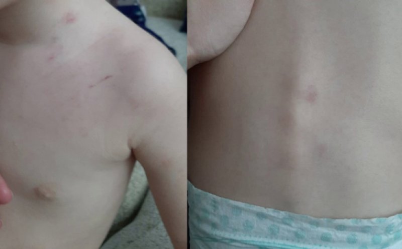 Scandal la o creșă din Cluj. O mămică și-a adus copilul acasă plin de vânătăi