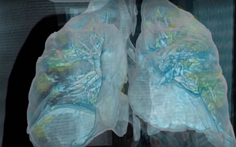 Cum atacă noul coronavirus plămânii. Clip 3D