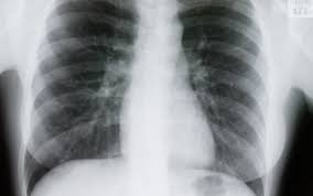 Ai avut COVID și crezi că ai trecut cu bine peste boală?  Medicii avertizează: trebuie făcute două investigații după vindecare