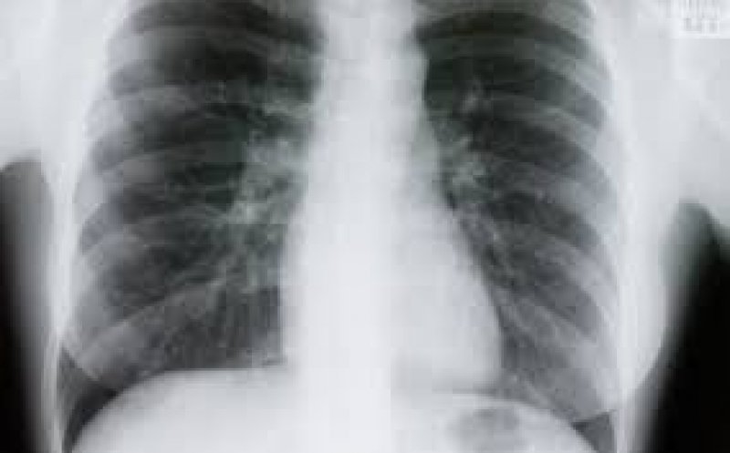 Ai avut COVID și crezi că ai trecut cu bine peste boală?  Medicii avertizează: trebuie făcute două investigații după vindecare