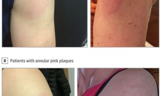 Roșeață, mâncărime și durere în braț după vaccinarea cu Moderna? Ce spune profu' de sănătate