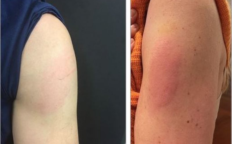 Roșeață, mâncărime și durere în braț după vaccinarea cu Moderna? Explicațiile lui Răzvan Cherecheș