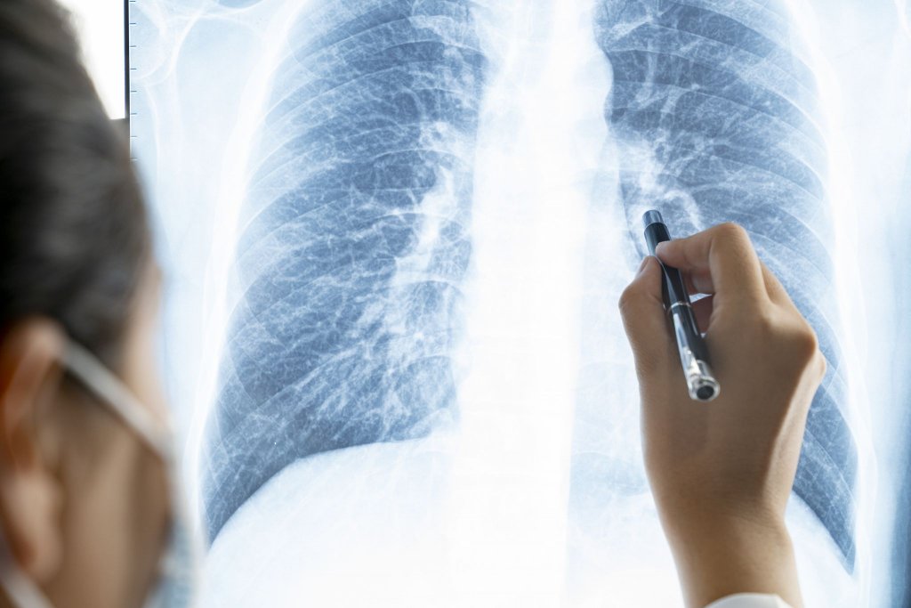 Medic: Peste 95% dintre persoanele vaccinate care fac COVID nu au plămânii afectați