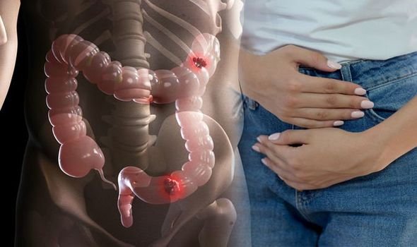 Care este simptomul subtil al cancerului intestinal. Diagnosticul precoce îți poate salva viața