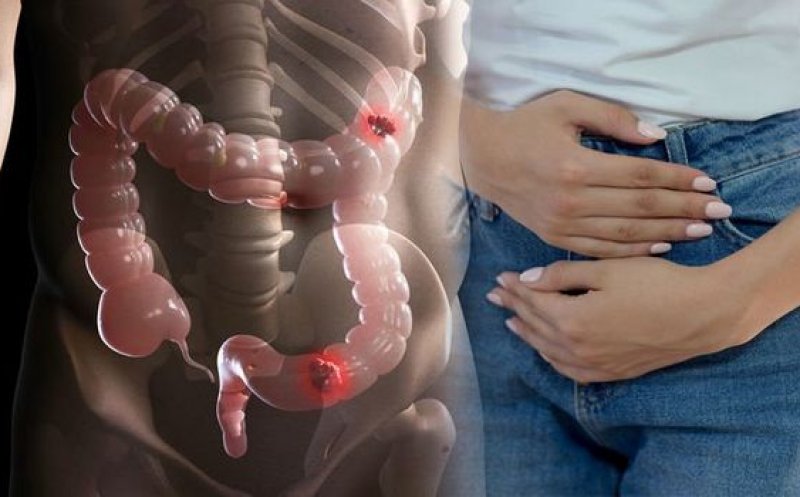 Care este simptomul subtil al cancerului intestinal. Diagnosticul precoce îți poate salva viața