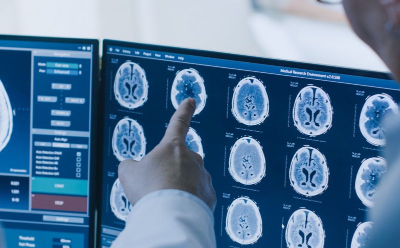 Strategia Naţională pentru Combaterea Bolilor Cerebrovasculare se lansează la Cluj-Napoca