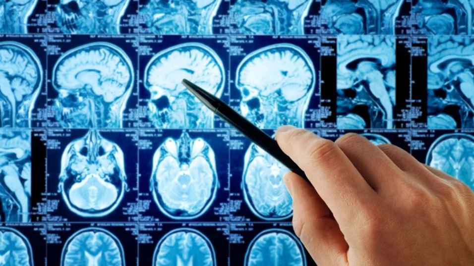 Tot mai mulți tineri diagnosticați cu tumori cerebrale. Care sunt cauzele