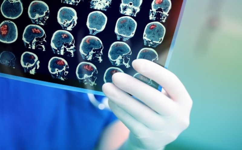 MS: Anual, 60.000 de români suferă anual un accident vascular cerebral/ Semnele unui AVC