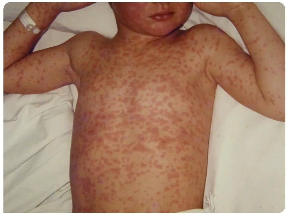 Epidemie de rujeolă. Pediatru: "Tocmai am vazut un caz sever din boala care nu există în România"