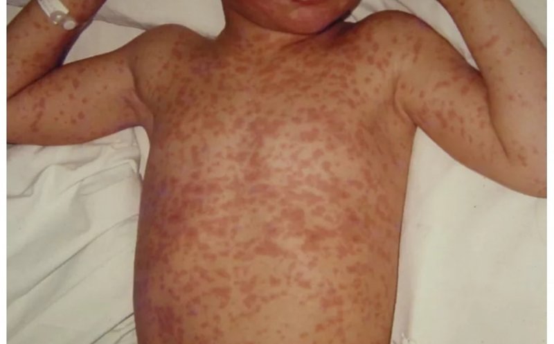 Epidemie de rujeolă. Pediatru: "Tocmai am vazut un caz sever din boala care nu există în România"