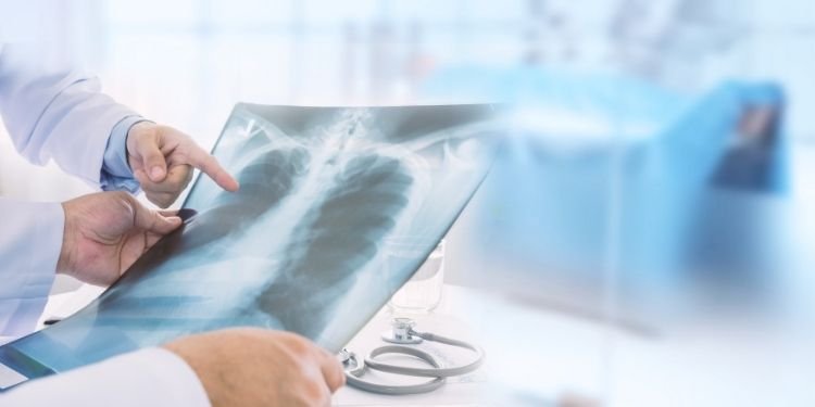 Medicii, în alertă! Ce este "sindromul plămânului alb". Pneumonia care face ravagii în China a ajuns și în Europa