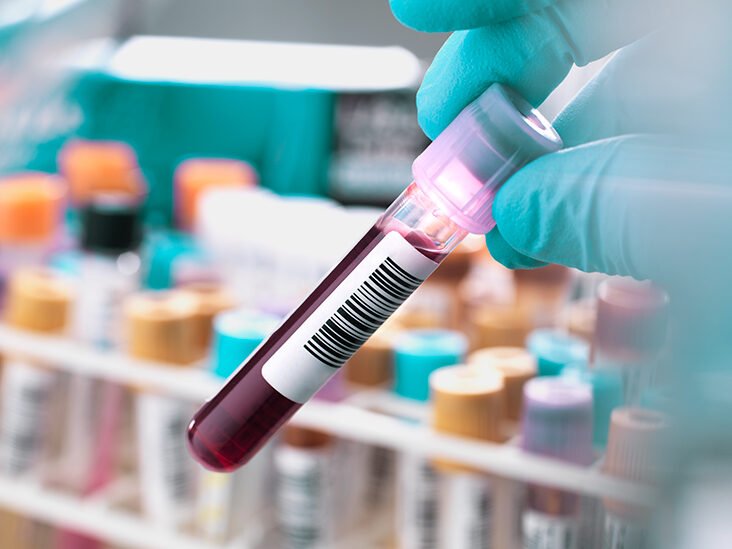 Maladia Alzheimer ar putea fi depistată înainte de apariția primelor semne cu un test de sânge