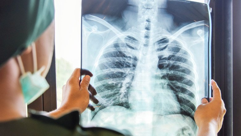 Medic: Aerul curat, soluţia pentru un plămân sănătos/ Cancerul pulmonar, cu cea mai mare mortalitate