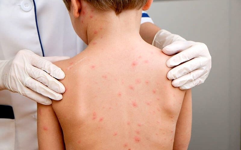 România a trecut de 8.000 de cazuri confirmate cu rujeolă. Cum stă Clujul cu îmbolnăvirile