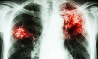 România, prima în UE la incidența cazurilor de tuberculoză. Rafila: "Observăm şi o suprapunere a situaţiei legate de poluare"