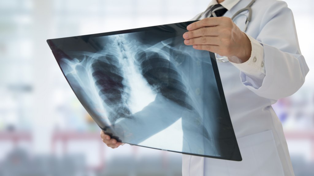 Medicii au descoperit un nou sindrom legat de Covid