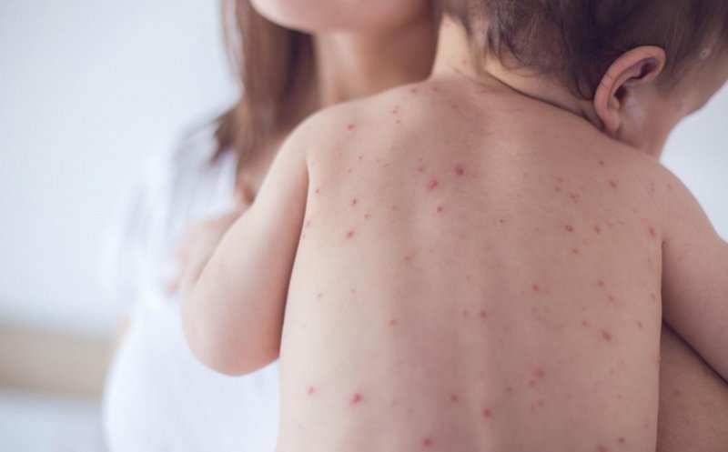 Un bebeluș a murit din cauza rujeolei. Mama şi fratele lui erau nevaccinaţi şi prezentau simptome de boală