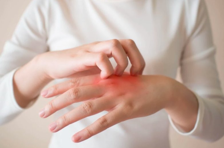 Peste 400.000 de români suferă de psoriazis. Care este vârsta medie de debut a bolii