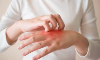 Peste 400.000 de români suferă de psoriazis. Care este vârsta medie de debut a bolii