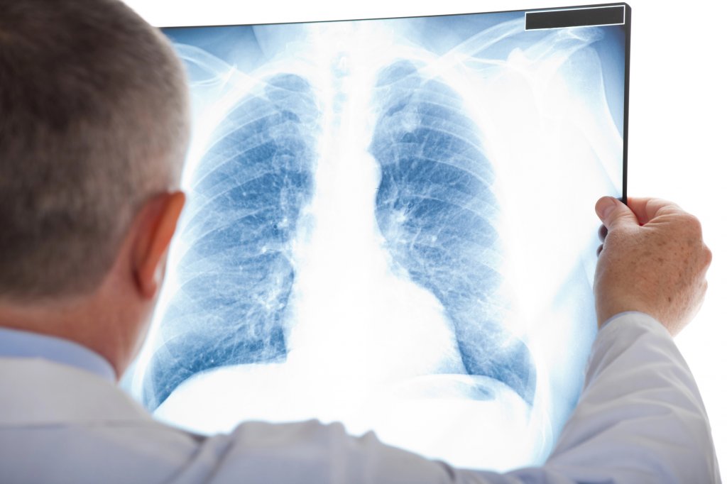 Primul test de urină care ar putea detecta cancerul pulmonar. În ce fază sunt testele