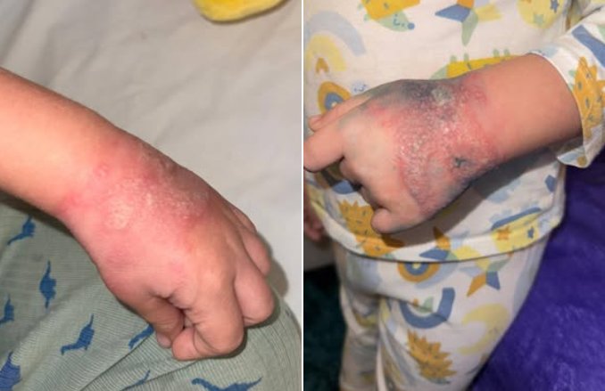 Anchetă la un spital, după ce un copil s-ar fi ales cu mâna tumefiată din cauza unei branule lăsată neschimbată mai multe zile