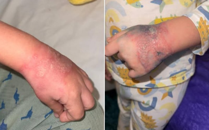 Anchetă la un spital, după ce un copil s-ar fi ales cu mâna tumefiată din cauza unei branule lăsată neschimbată mai multe zile