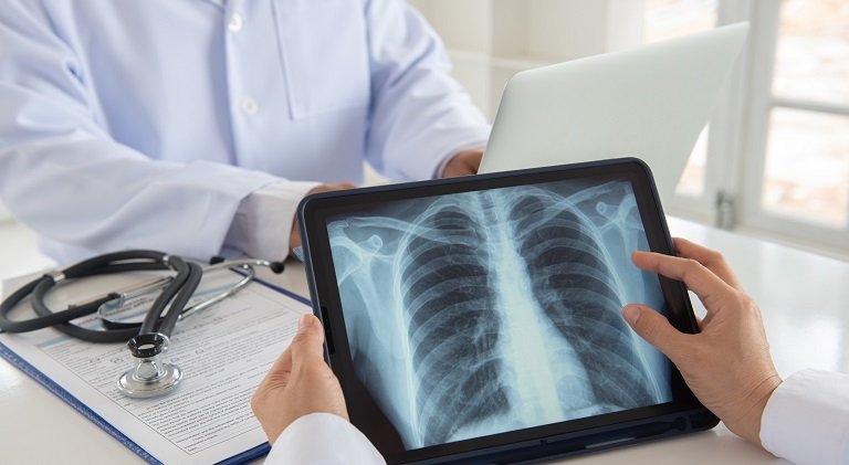 Cazurile de cancer pulmonar, în creştere în rândul nefumătorilor din întreaga lume. Care ar fi explicația