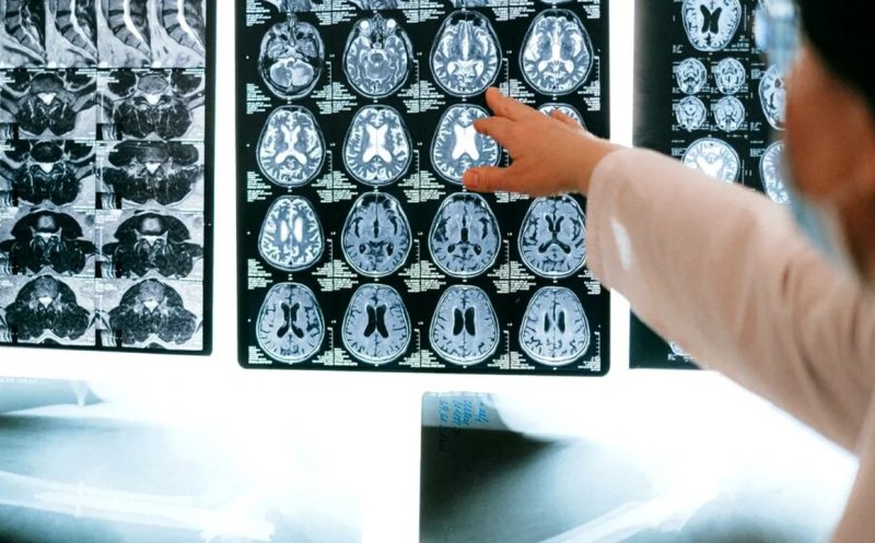 Prevenția AVC: 8 metode esențiale pentru a reduce riscul de accident vascular cerebral