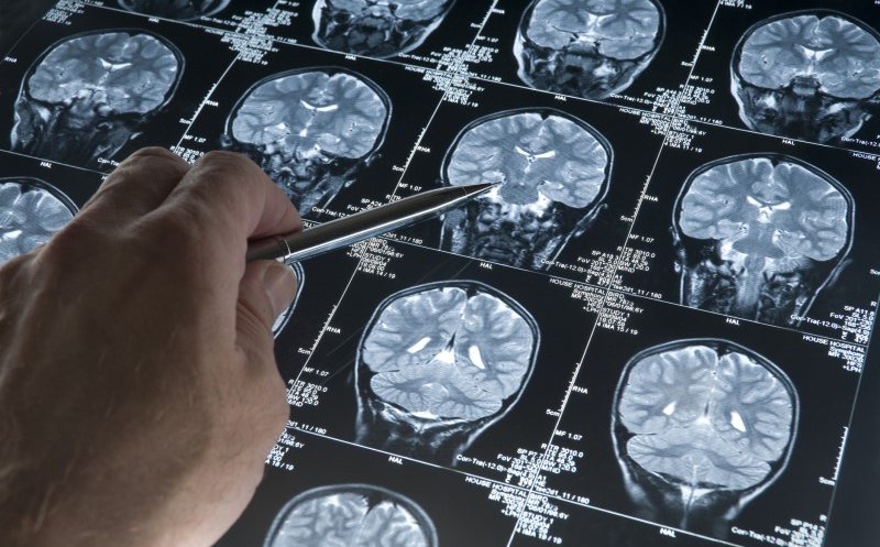14 factori care pot reduce cu 45% cazurile de demență dacă știm cum să-i gestionăm