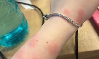 Ciuruită de ploșnițe la cușeta CFR Călători pe ruta București - Sighet / 13 ore în ”trenul groazei ”, la 190 de lei