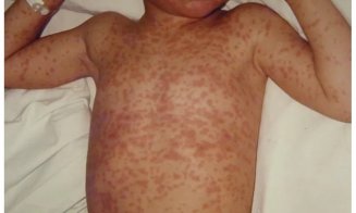 Alarmant! 30 de decese și aproape 36.000 de cazuri cu rujeolă înregistrate în România. Cele mai multe infectări, la cei nevaccinați