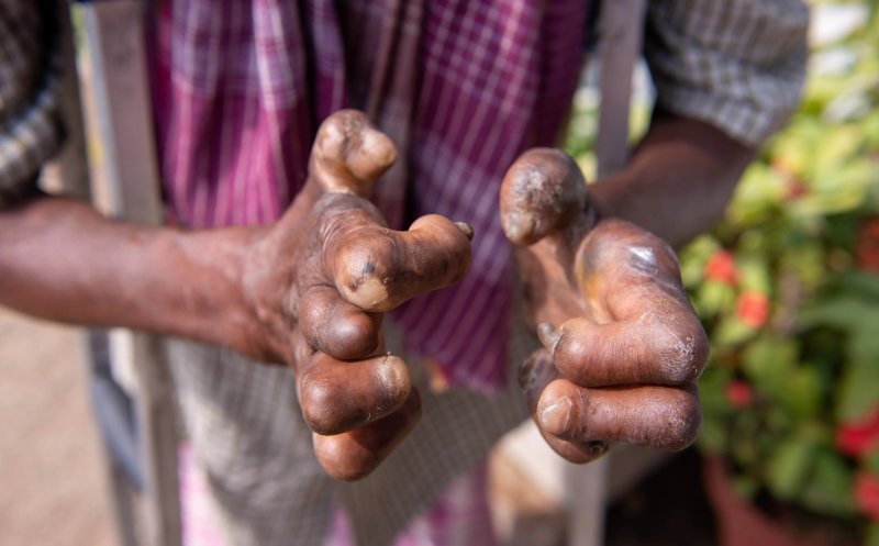 Caz de lepră depistat la Cluj la o femeie din Indonezia care lucra la un salon de masaj. Alte trei maseuze sunt monitorizate