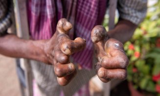 Caz de lepră depistat la Cluj la o femeie din Indonezia care lucra la un salon de masaj. Alte trei maseuze sunt monitorizate