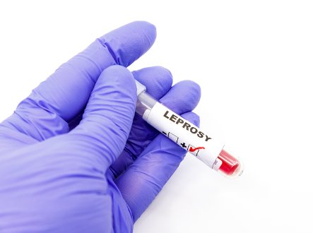 Reapare lepra în Europa? Croația confirmă un caz, România are deja două, ambele la Cluj