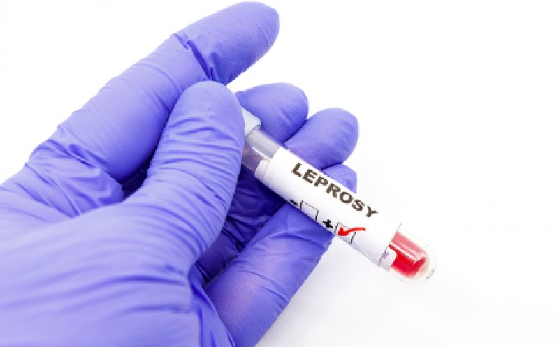 Reapare lepra în Europa? Croația confirmă un caz, România are deja două, ambele la Cluj